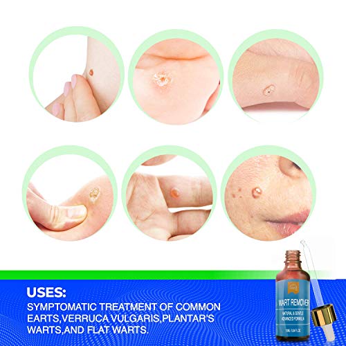 Wart Remover Liquid Rapidly Eliminates Both Plantar and Common Warts, Papillo...