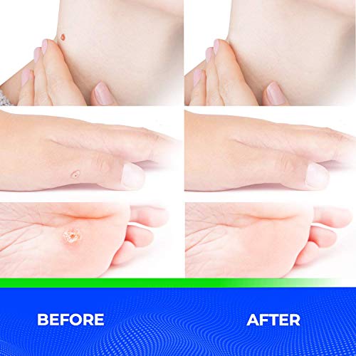 Wart Remover Liquid Rapidly Eliminates Both Plantar and Common Warts, Papillo...
