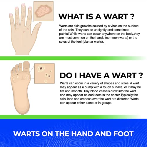 Wart Remover Liquid Rapidly Eliminates Both Plantar and Common Warts, Papillo...
