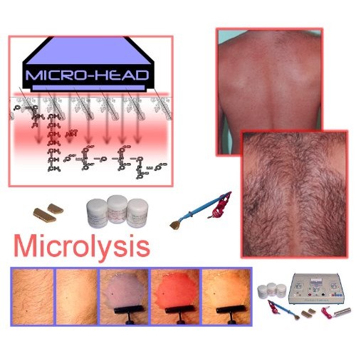 Aavexx 300 Microlysis Cost Effective Home-Use-System, Non Invasive Hair Removal!
