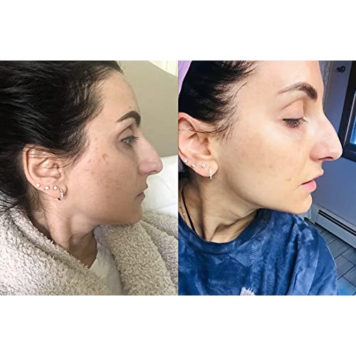 Admire My Skin Dark Spot Corrector Remover for Face - Brightening Serum Fade ...