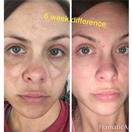 Admire My Skin Dark Spot Corrector Remover for Face - Brightening Serum Fade ...