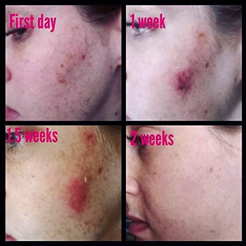 Admire My Skin Dark Spot Corrector Remover for Face - Brightening Serum Fade ...