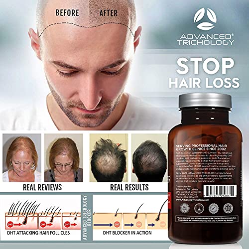 DHT Blocker - Hair Growth Supplement for Genetic Thinning for Men and Women |...