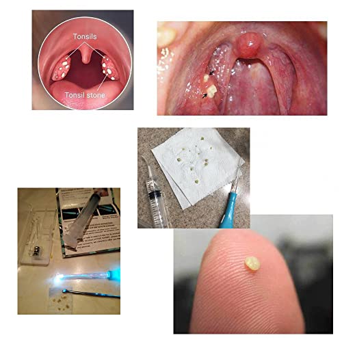 Airgoesin™ Upgraded Tonsil Stone Remover Tool or Earwax Removal, Blue, 5 Tips...