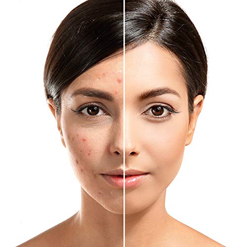 Blackhead remover,Acne treatment,Pimple Popper,Face Skin Care Kit,Professiona...