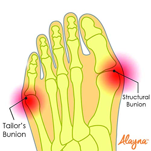 Bunion Corrector for Women and Men Big Toe Bunion Pain Relief Hallux Valgus C...
