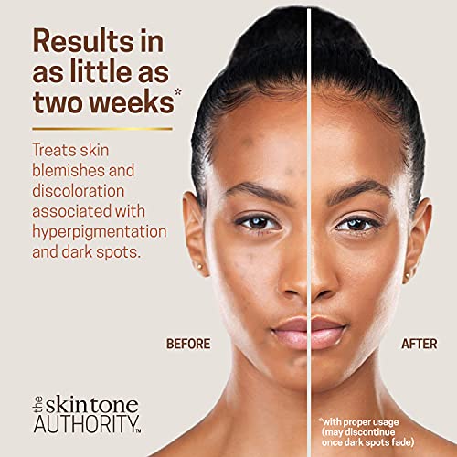 Ambi Skincare Fade Cream for Normal Skin | Dark Spot Remover for Face and Bod...