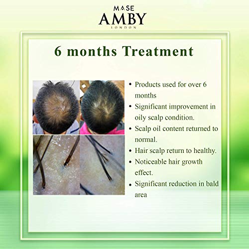 Amby London Degrease Shampoo For Oily Hair Women Men - Smelly Scalp Shampoo F...