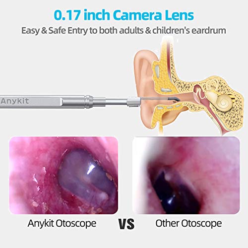 Ear Wax Removal Tool, Ear Spoon, Ear Pick for Anykit NTE430, NTE100i Otoscope...