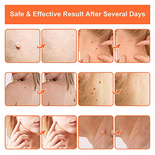 Skin Tag Remover Patches - (108 Pcs) Natural and Fast-Acting Skin Remover Pat...