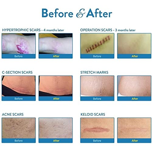 Aroamas Professional Silicone Scar Sheets, Soften and Flattens Scars Resultin...