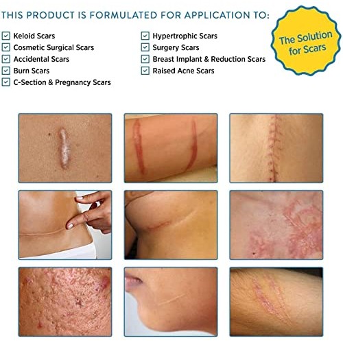 Aroamas Professional Silicone Scar Sheets, Soften and Flattens Scars Resultin...