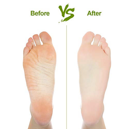 2PCS Natural Pumice Stone for Feet - Asqraqo Lava Pedicure Tools Hard Skin Ca...