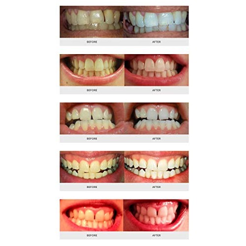 AuraGlow Teeth Whitening Kit, LED Light, 35% Carbamide Peroxide, (2) 5ml Gel ...