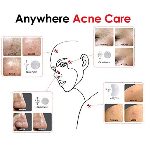 Ax Acne Hydrocolloid Pimple Patch Bandage 176 Variety Pack Skincare Pore Stri...