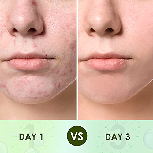 BAGLAK Hydrocolloid Large Acne Pimple Patches (22 Strips), XL Size, Larger Br...