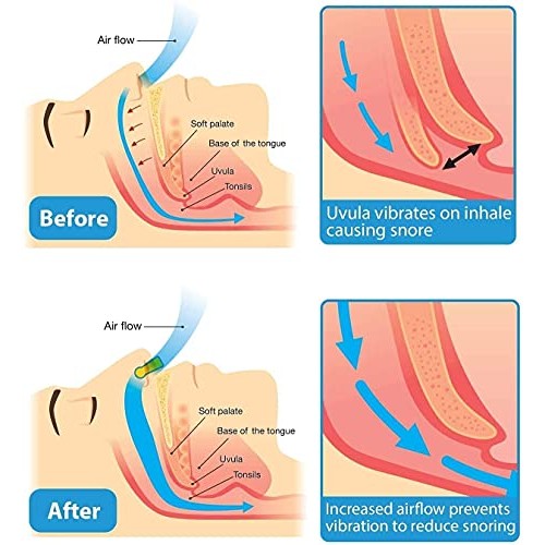 Anti Snoring Devices - Silicone Magnetic Anti Snoring Nose Clip, Snoring Solu...