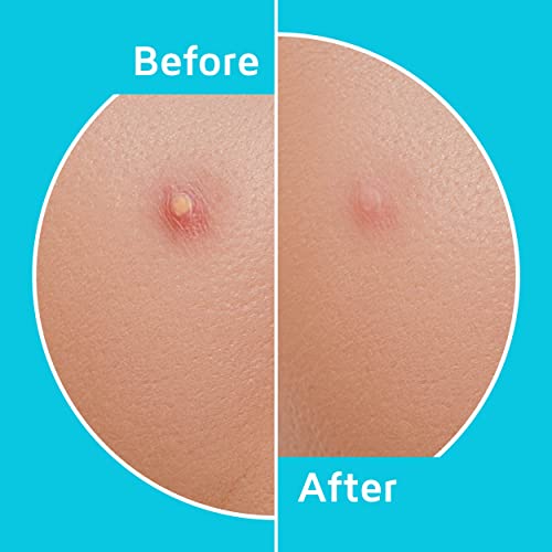 Acne Patches (120 Pack), Tea Tree Oil and Hydrocolloid Pimple Patches for Fac...