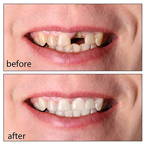 tooth repair kit, 100 g tooth filling thermal beads, temporary veneer tooth r...