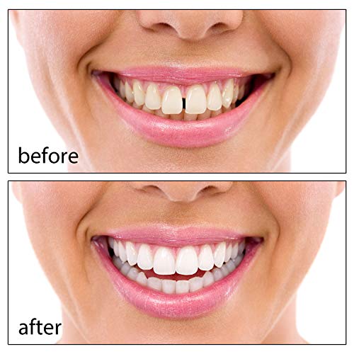 tooth repair kit, 100 g tooth filling thermal beads, temporary veneer tooth r...