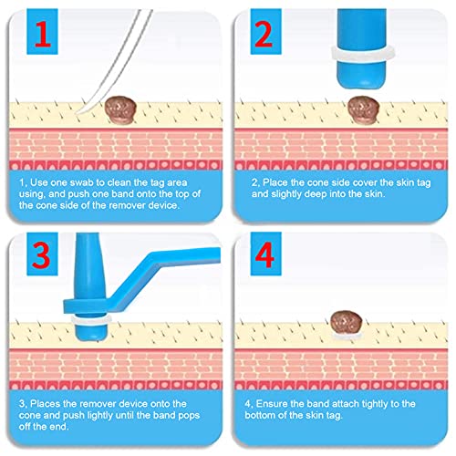 30Pcs Skin Tag Removal Rubber Bands, Skin Tag Remover Device, Safe Micro Band...