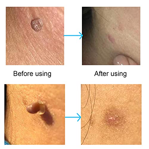 30Pcs Skin Tag Removal Rubber Bands, Skin Tag Remover Device, Safe Micro Band...