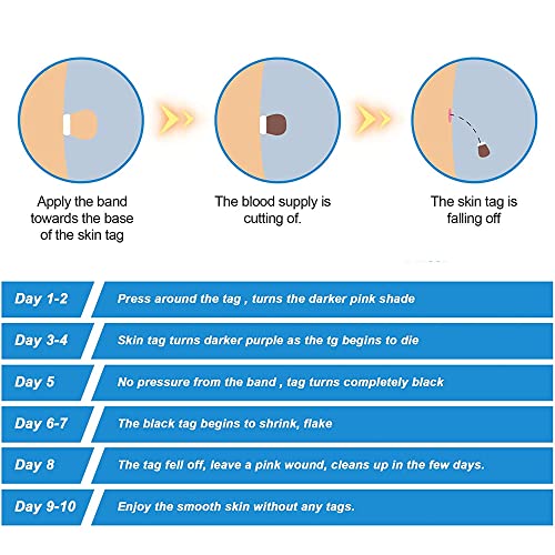 2 in 1 Skin Tag Remover for Small/Medium Skin Tags, Wart Removal Painless and...