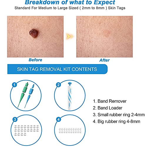 2 in 1 Skin Tag Remover for Small/Medium Skin Tags, Wart Removal Painless and...