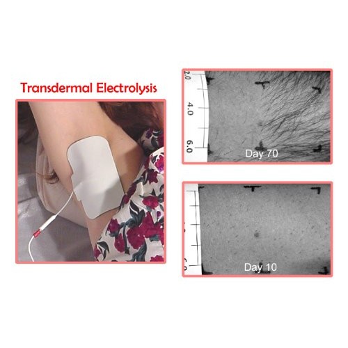 Permanent Hair Removal Transdermal Electrolysis Machine.