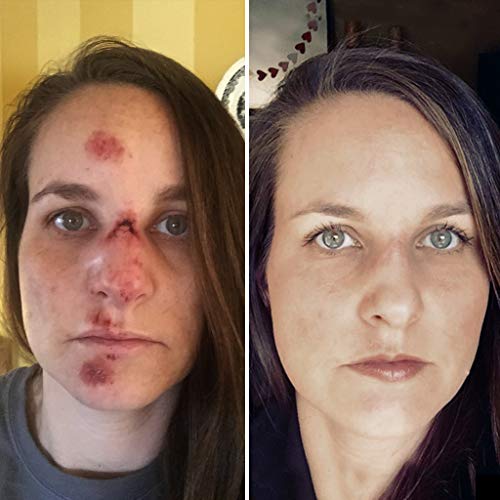 Brave Soldier Antiseptic Quick Healing Ointment with Tea Tree Oil,1 Ounce, Qu...