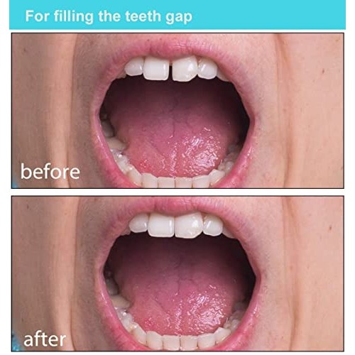 Brige Temporary Tooth Repair kit for Filling The Missing Broken Tooth and Gap...