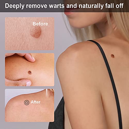 2 Pack Foot Skin Removal Cream,Foot Care Removal Cream,Mole Cream