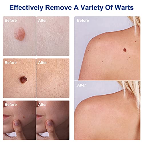 2 Pack Foot Skin Removal Cream,Foot Care Removal Cream,Mole Cream