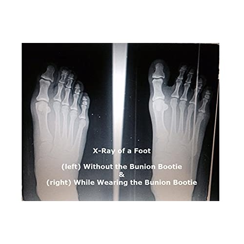 Bunion Bootie Bunion Corrector for Women Big Toe, Ultra-Thin Bunion Corrector...