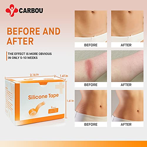 Carbou Silicone Scar Tape (1.6” x 60”Roll),Medical Silicone Easy-Tear Gel Tap...