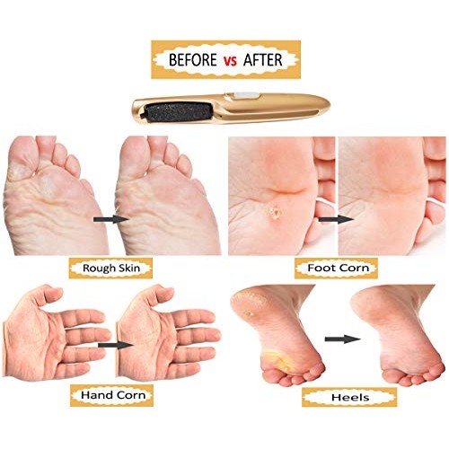 Powerful Electric Foot Callus Removers – Rechargeable Electronic Foot File Re...