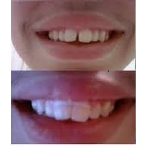 Cayenas Orthodontic Gap Teeth Bands 3/16 Heavy - 100 Bands Per Pack