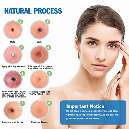 Skin Tag Removal - All Natural Mole and Skin Tag Remover and Repair Lotion- L...