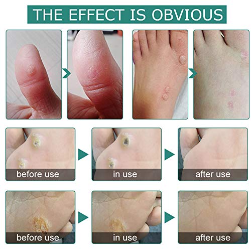 Wart Remover, Plantar Wart Removal, Corn Callus Remover, Wart Removal with Na...