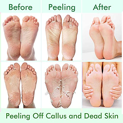5 Pack Foot Peel Mask,Exfoliator Peel Off Calluses Dead Skin Callus Remover,F...