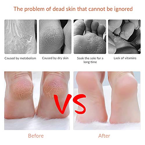 Codream Pedicure Callus Shaver Foot File Care Hard Skin Remover Callus Shaver...