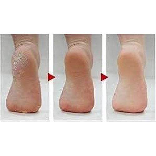 Mini Disposable Pumice Sponge Block 400 Pcs - Callus Remover for Feet Heels Palm