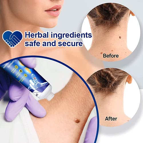 2PCS Wart Remover, Skin Wart Removal Cream Warts Cream Foot Care Cream Skin T...