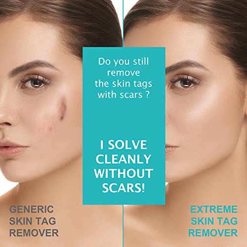 Skin Tag Remover Cream, Wart & Mole Remover - Quickly and Easily Remove Commo...