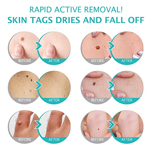 Skin Tag Remover Cream, Wart & Mole Remover - Quickly and Easily Remove Commo...