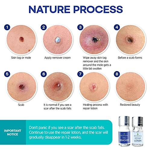Skin Tag Remover, Mole Remover and Repair Gel Set, Skin Tag Removal Treatment...
