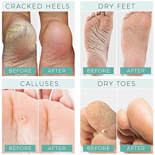 Foot Peel Mask - Coconut - For Cracked Heels, Dead Skin Calluses - Make Your ...