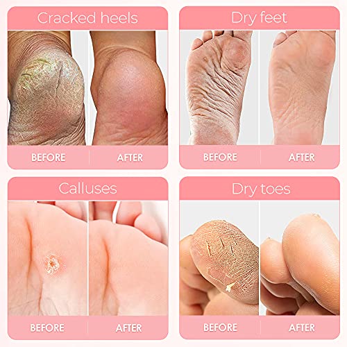 Foot Peel Mask - Peach - For Cracked Heels, Dead Skin & Calluses - Makes Your...