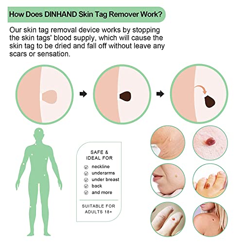 DINHAND Skin Tag Remover, Micro Skin Tag Removal Kit for Small to Medium (2mm...